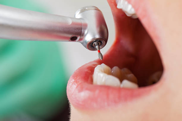 Best Emergency Dental Extractions in Brook Park, OH